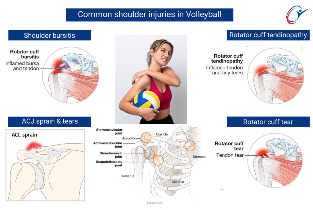 Volleyball Sport Science Injuries - Upper Limb - Shoulder - Rotator ...