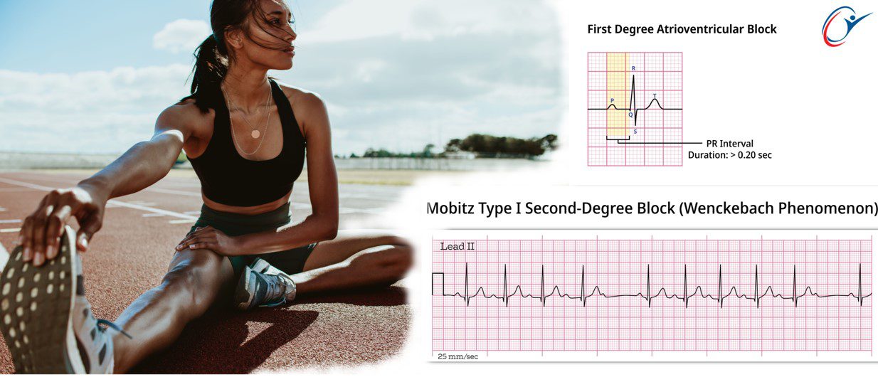 First Degree Atrioventricular Block