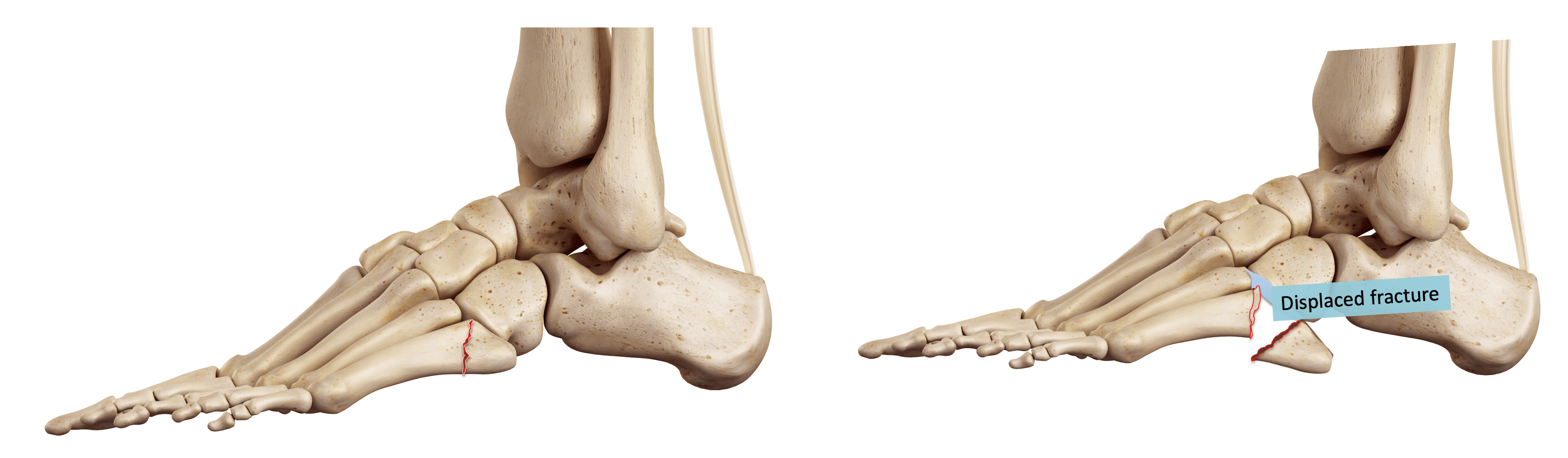 Jones Foot Ankle & Foot - Jones Fracture | ASSIC Education