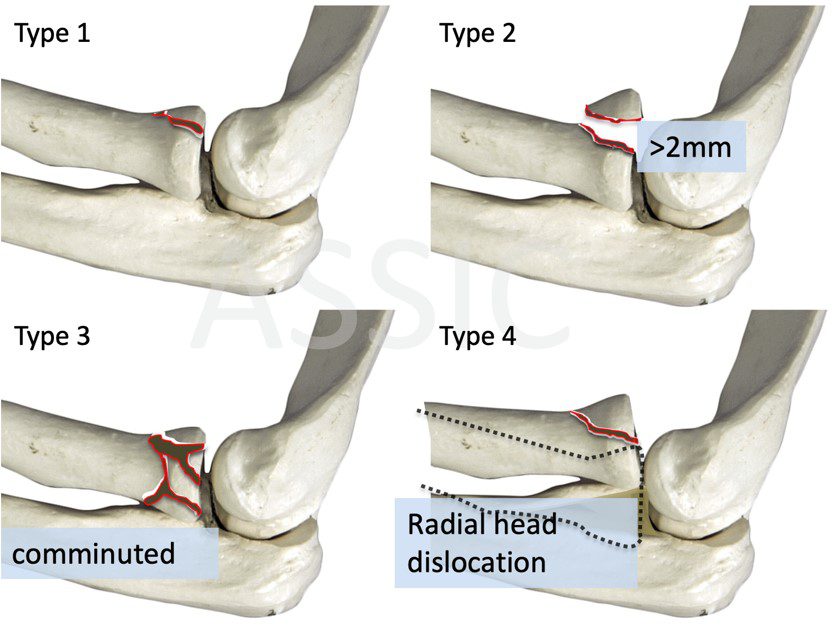 Rugby Sport Science Injuries - Upper Limb - Elbow & Forearm - Elbow ...