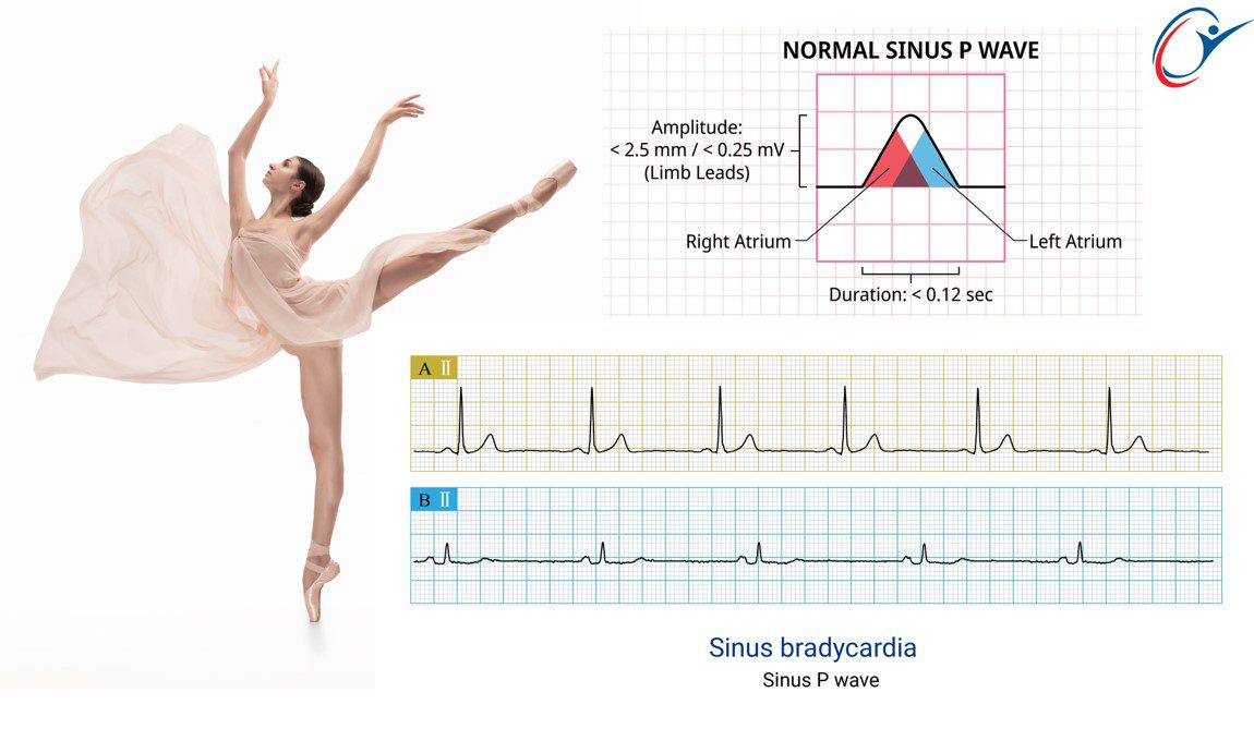 Normal Sinus P Wave