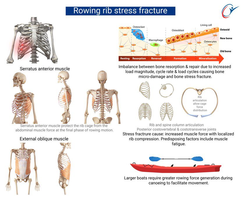 Rib Cage - Rib Fractures | ASSIC Education