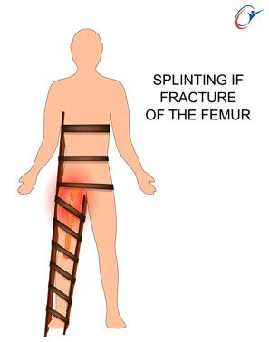 Splinter Injury Leg First Aid Limb Fracture Practical - Lower Limb Splint | ASSIC Education
