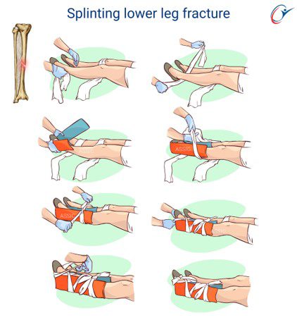 Splinter Injury Leg First Aid Limb Fracture Practical - Lower Limb Splint | ASSIC Education