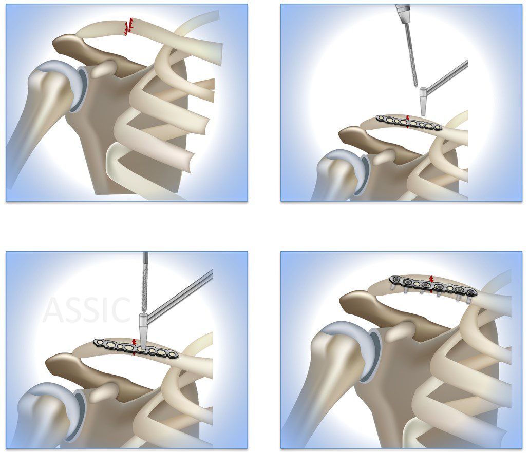 Judo Sport Science Injuries - Trunk - Chest - Clavicle Fracture | ASSIC ...
