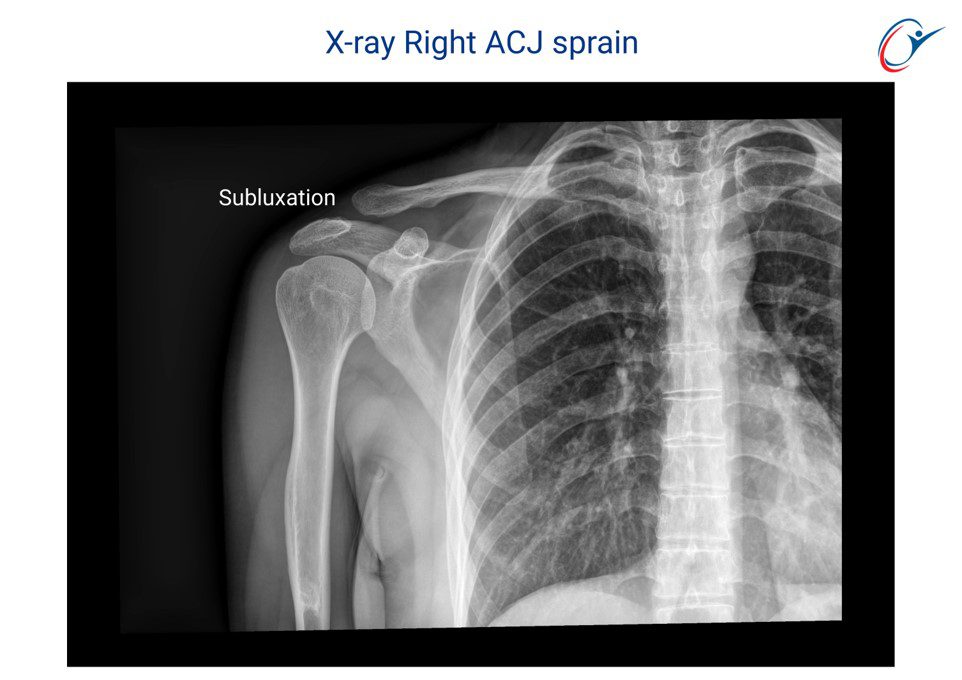 Cricket Sport Science Injuries - Upper Limb - Shoulder & Arm - ACJ ...