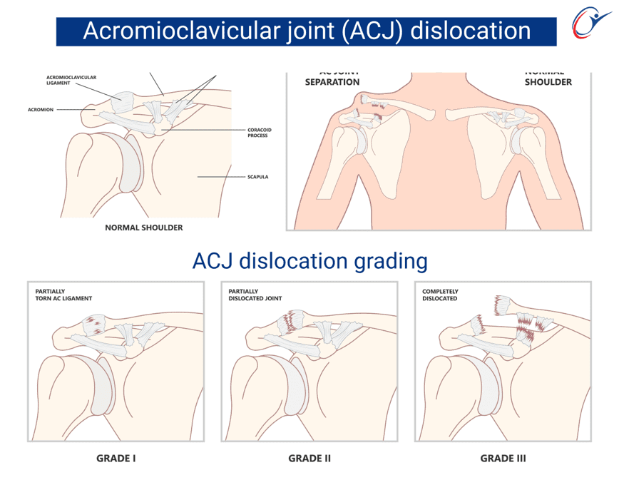 Swimming Sport Science Injuries - Upper Limb - Shoulder - ACJ Sprain ...