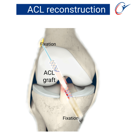 Knee - ACL Tear | ASSIC Education
