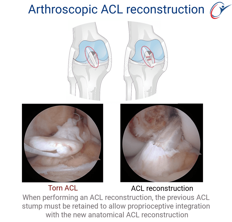 Knee - ACL Tear | ASSIC Education