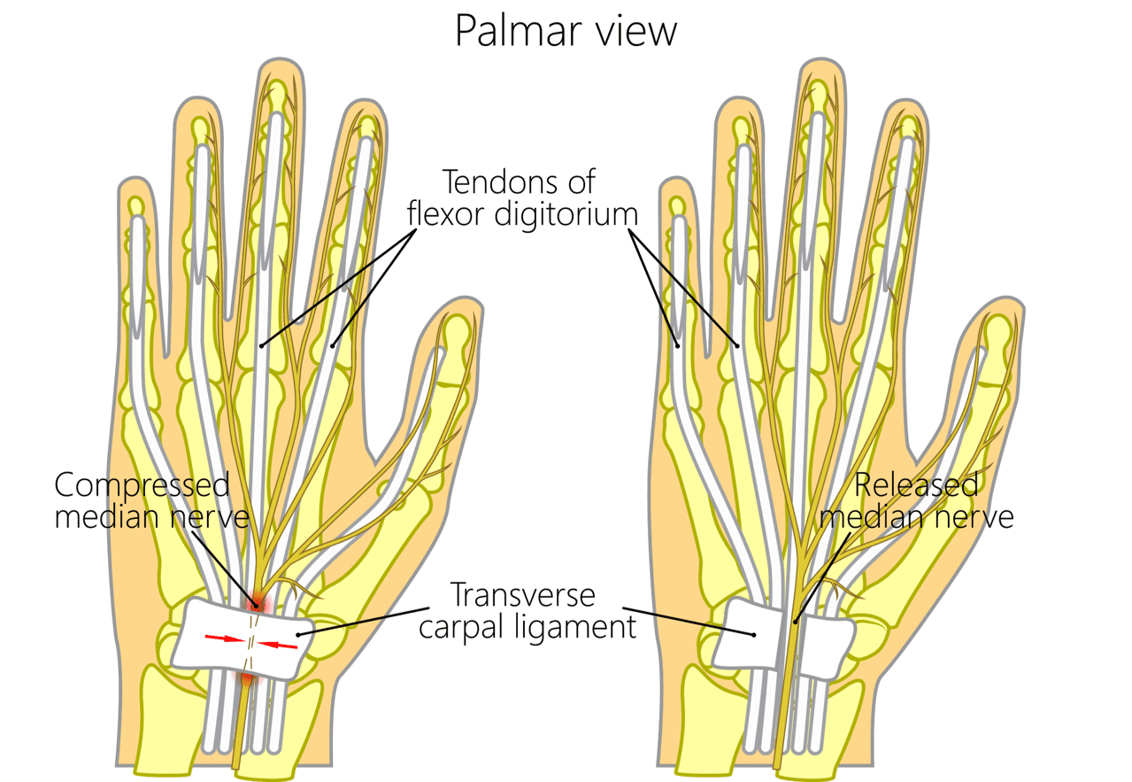 Wrist & Hand - Carpal Tunnel Syndrome | ASSIC Education