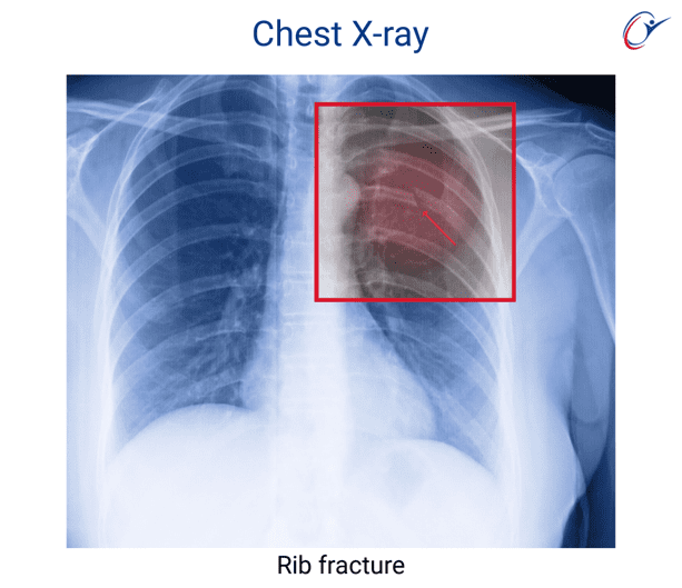 Judo Sport Science Injuries - Trunk - Chest - Rib Cage | ASSIC Education