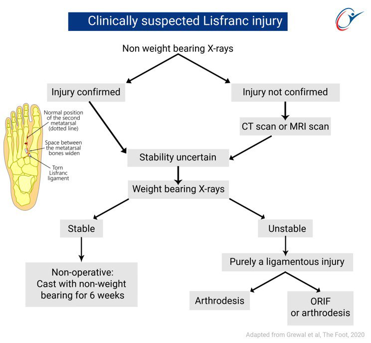 Lisfranc Injury In Bodybuilding | ASSIC Education