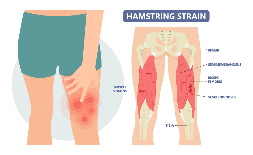 Leg Hamstring Atrophy Upper Leg - Acute Hamstring Tears | ASSIC Education