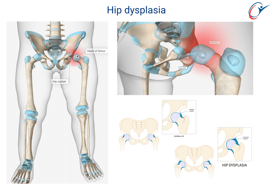hip-dysplasia