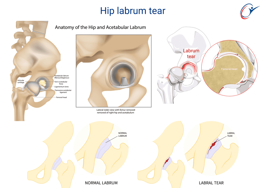 hip-labrum-tear