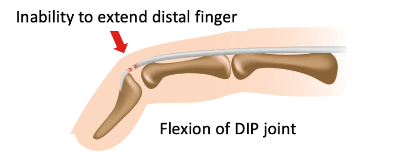 Netball Finger Injry Netball Injuries Part 1 | ASSIC Education