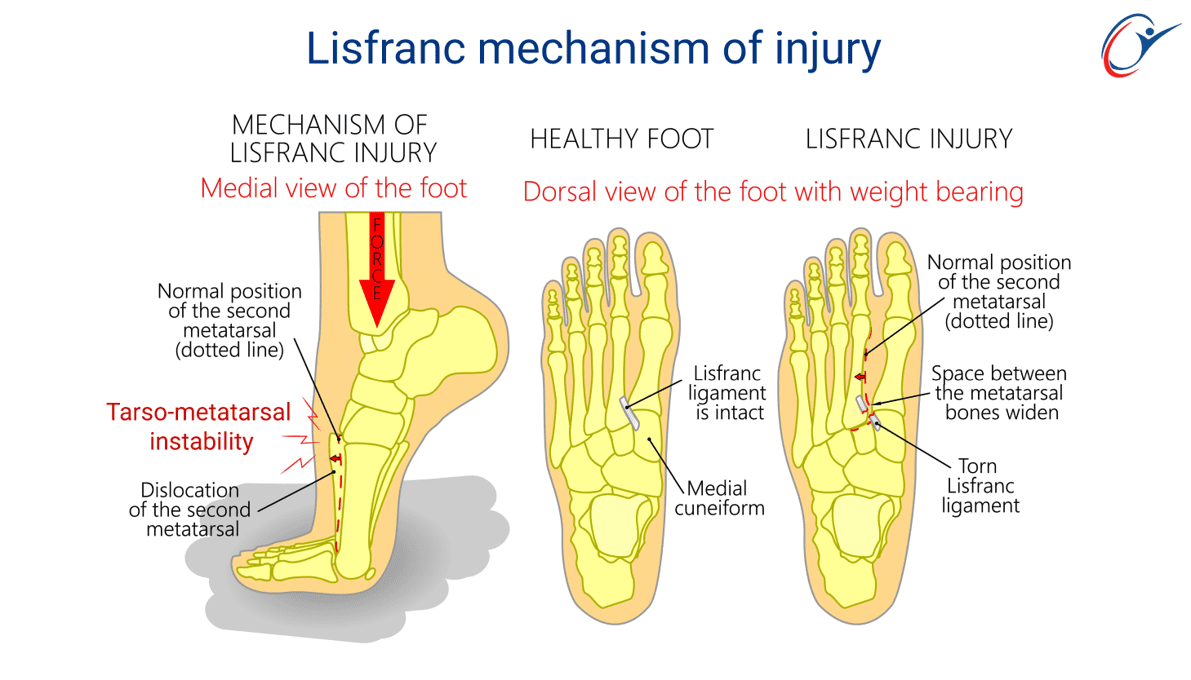 Ankle & Foot - Lisfranc Injury | ASSIC Education