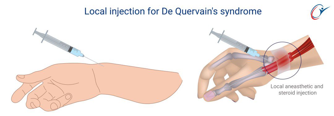 Stanetic Inection Wrist & Hand - De Quervain's Syndrome | ASSIC Education