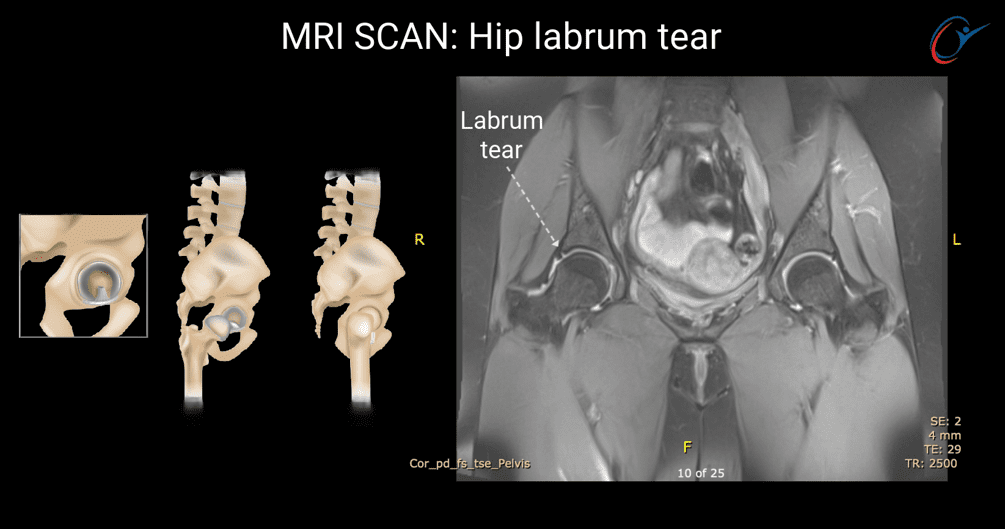 mri-scan-hip-labrum-tear