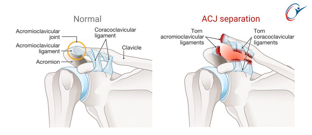 Shoulder - ACJ Sprain & Subluxation | ASSIC Education