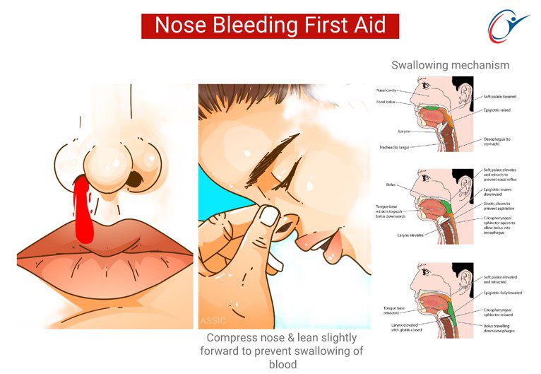 First Aid Nose Bleeding Practical - Nose Bleed Initial Management ...