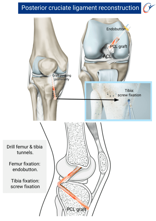 Pcl Inlay Knee - PCL Tear | ASSIC Education