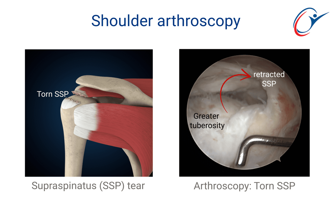 Shoulder - Rotator Cuff Tear | ASSIC Education