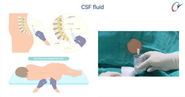 Emergency Care Seizures Practical - Lumbar Puncture | ASSIC Education