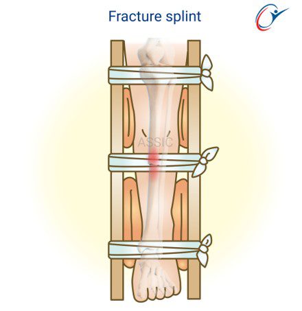Splinter Injury Leg First Aid Limb Fracture Practical - Lower Limb Splint | ASSIC Education