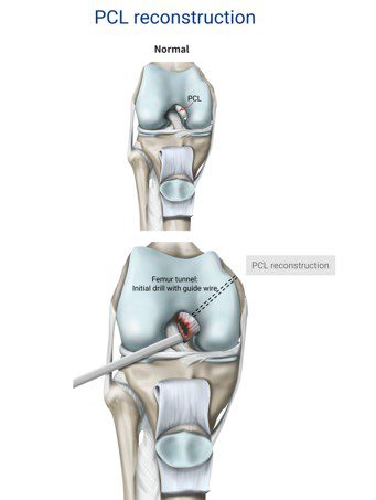 Pcl Inlay Posterior Cruciate Ligament Surgery Technique | ASSIC Education