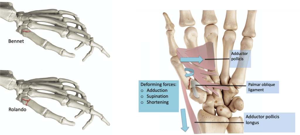 Wrist & Hand - Thumb Metacarpal Fracture | ASSIC Education