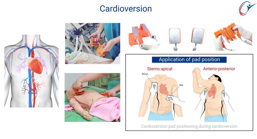 Cardioversion 100j Emergency Care Emergency Triage Practical - Cardioversion | ASSIC Education
